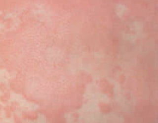 Dermatitis procesionaria del pino